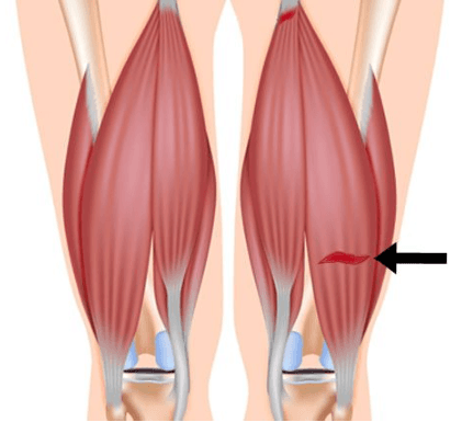 Hamstring Ruptuur Wat Te Doen Bij Een Hamstringblessure? | Fysiotherapie4all